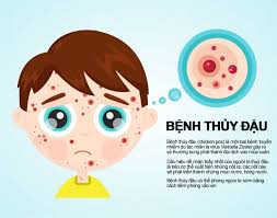Gia tăng mắc bệnh thủy đậu ở trẻ em tại nhiều tỉnh miền Bắc, cha mẹ đừng chủ quan