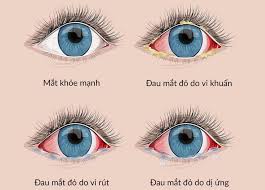 Bài truyền thông Bệnh đau mắt đỏ và cách phòng bệnh